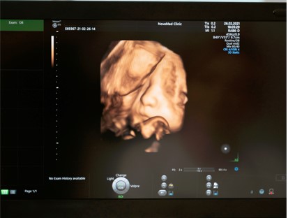 Ecografía de feto en 3D