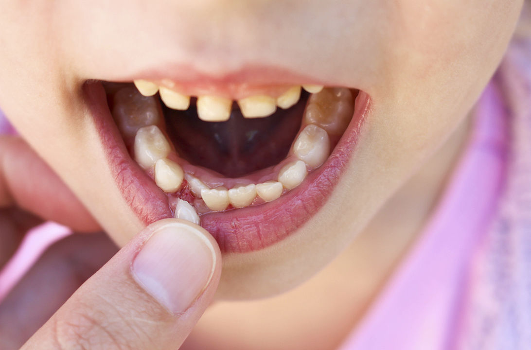 Cómo sacar un diente a un niño cuando se le mueve? | Consumer