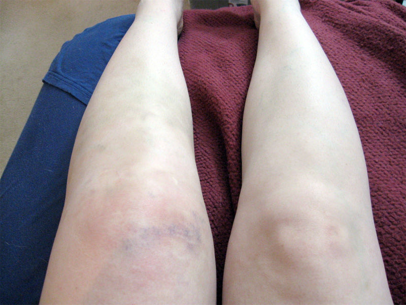Las mujeres somos más propensas a sufrir lesiones de rodilla