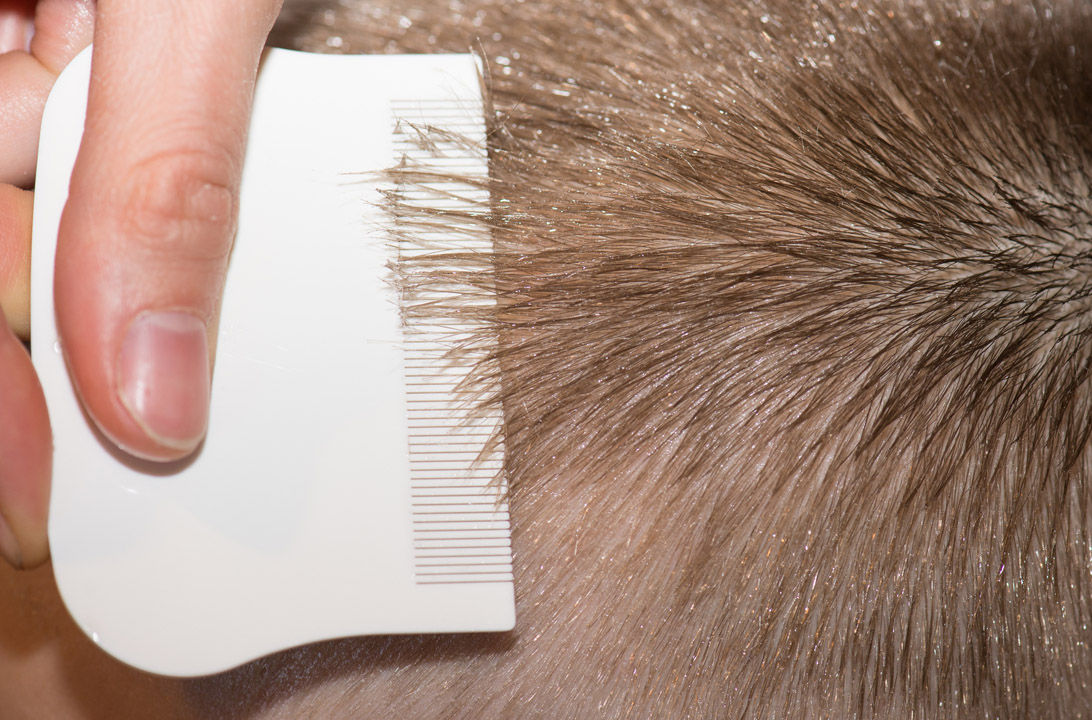 El tratamiento correcto de los piojos Consumer