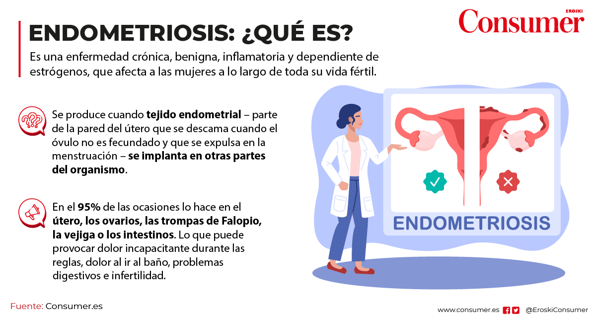 qué es la endometriosis