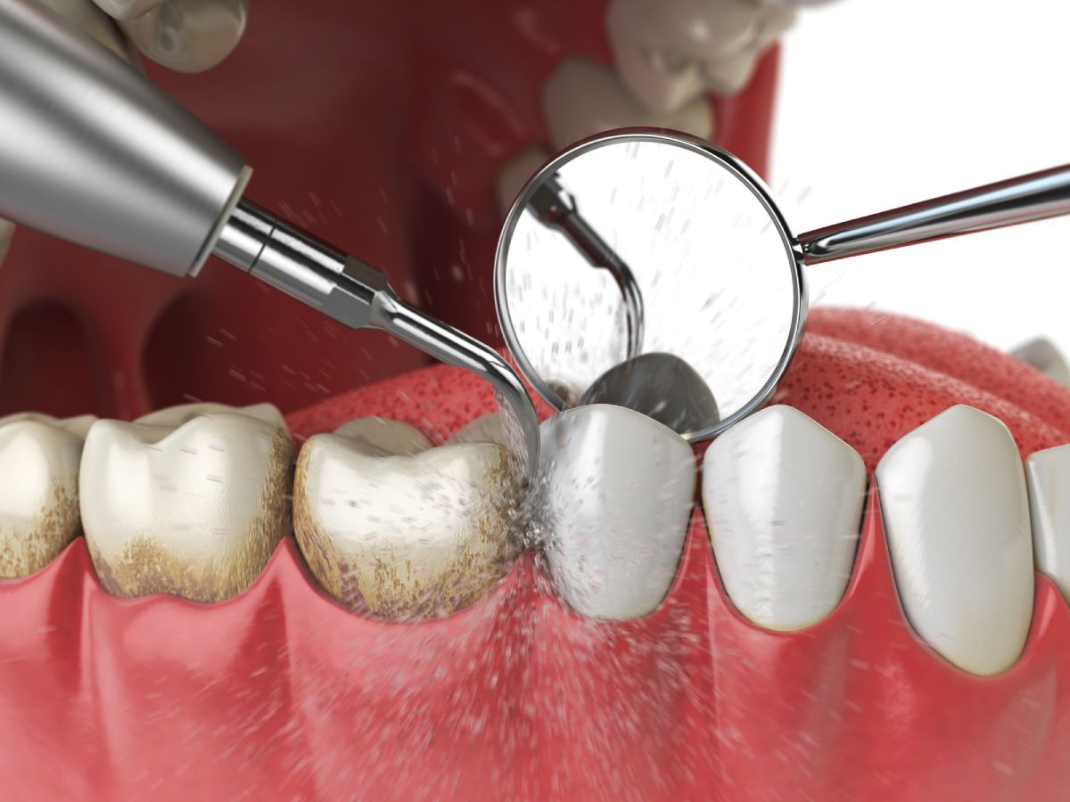 limpieza dental por ultrasonido