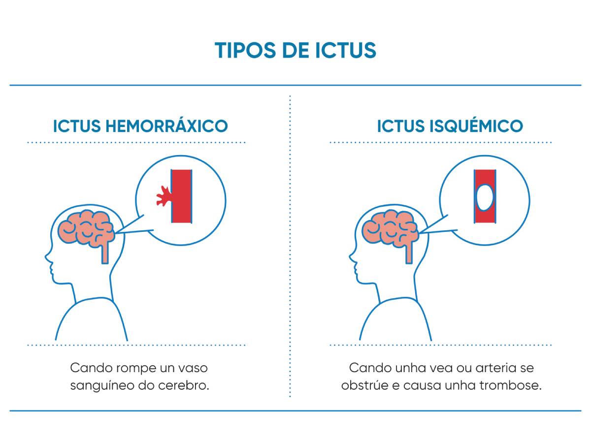 tipología ictus