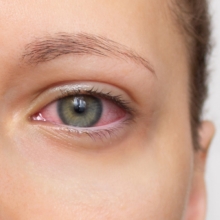 conjuntivitis alérgica síntomas y tratamiento