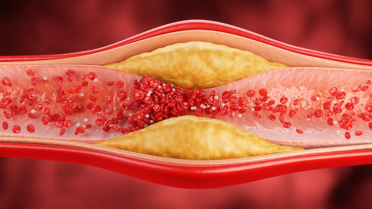lipoproteína y riesgo cardiovascular