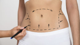 Img abdominoplastia hd