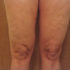 Img celulitis