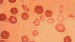Img anemia