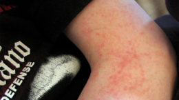 Img dermatitis