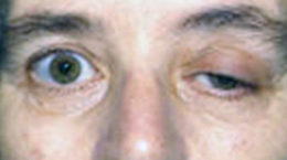 Img ptosis