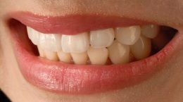 limpieza dental por ultrasonido riesgos