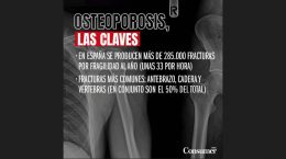 osteoporosis infografía