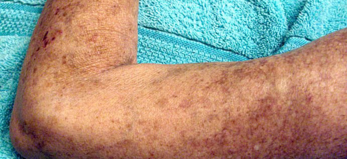Descubiertas Las Claves De La Esclerodermia Una Enfermedad De La Piel 