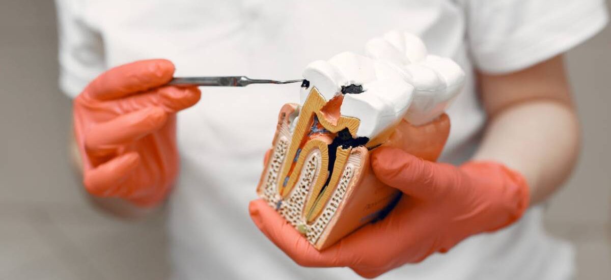 caries dental