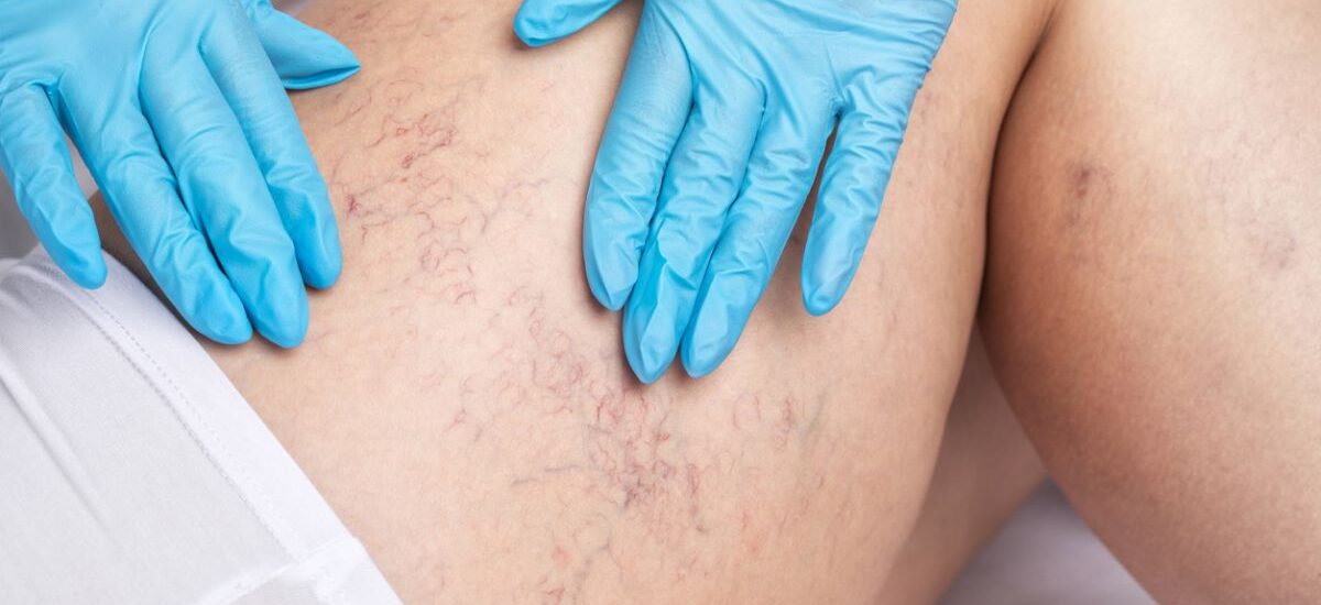 arañas vasculares cómo se quitan