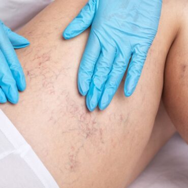 arañas vasculares cómo se quitan