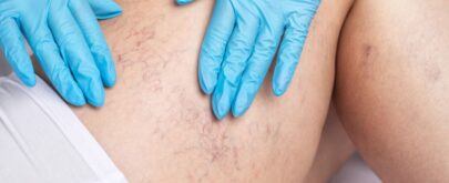 arañas vasculares cómo se quitan