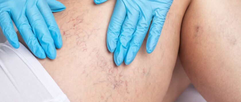 arañas vasculares cómo se quitan