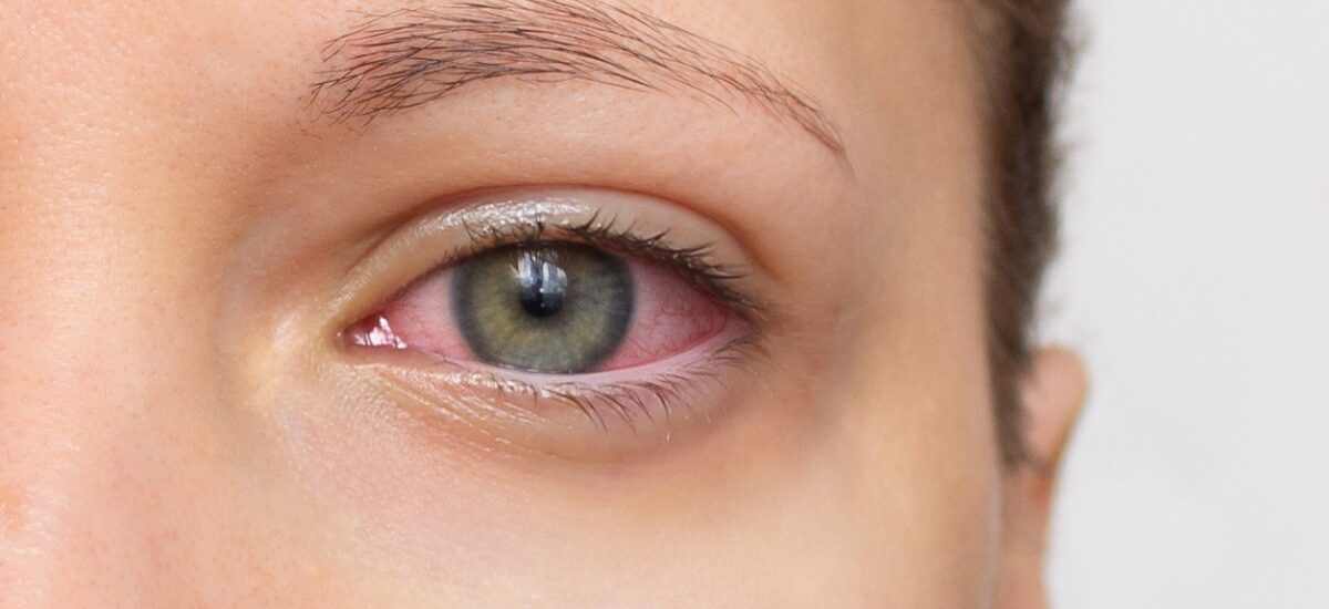 conjuntivitis alérgica síntomas y tratamiento