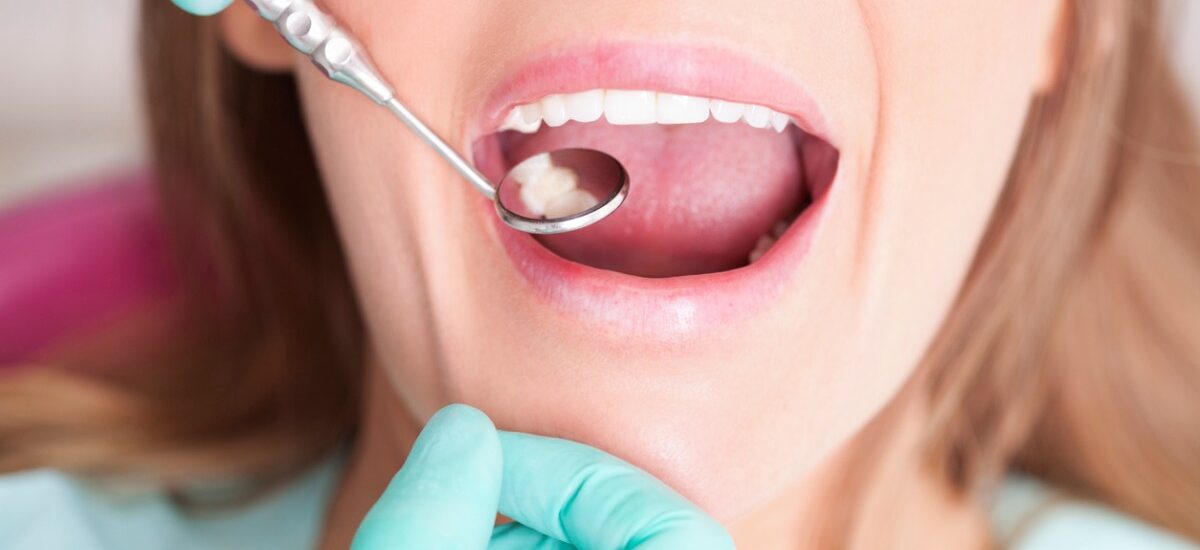 extracción de muelas del juicio