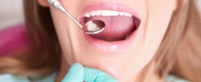 extracción de muelas del juicio