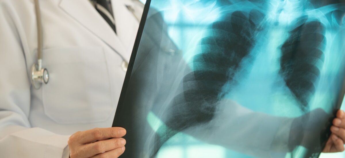 diagnóstico de tuberculosis