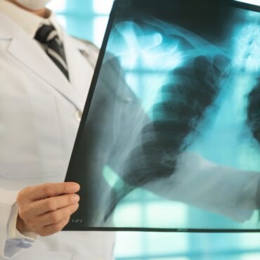 diagnóstico de tuberculosis