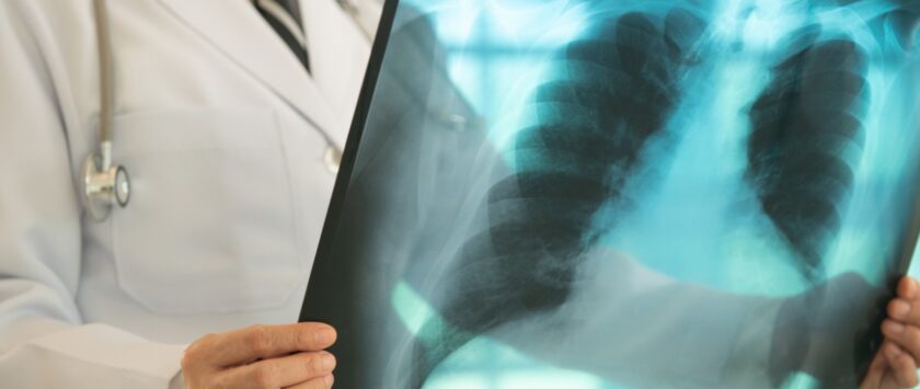 diagnóstico de tuberculosis