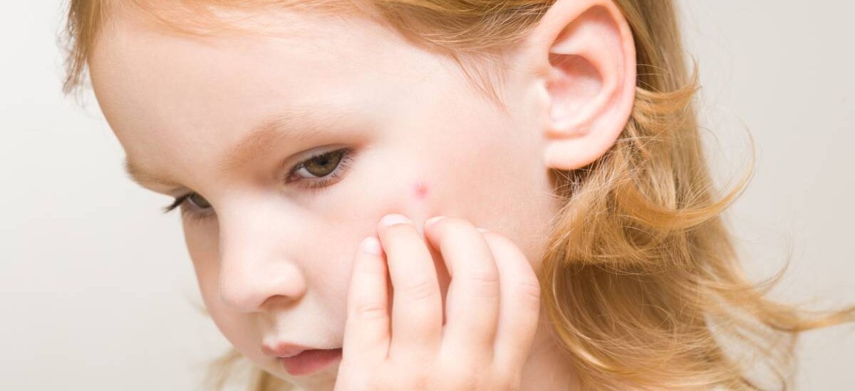picor-impetigo-cara piel impétigo