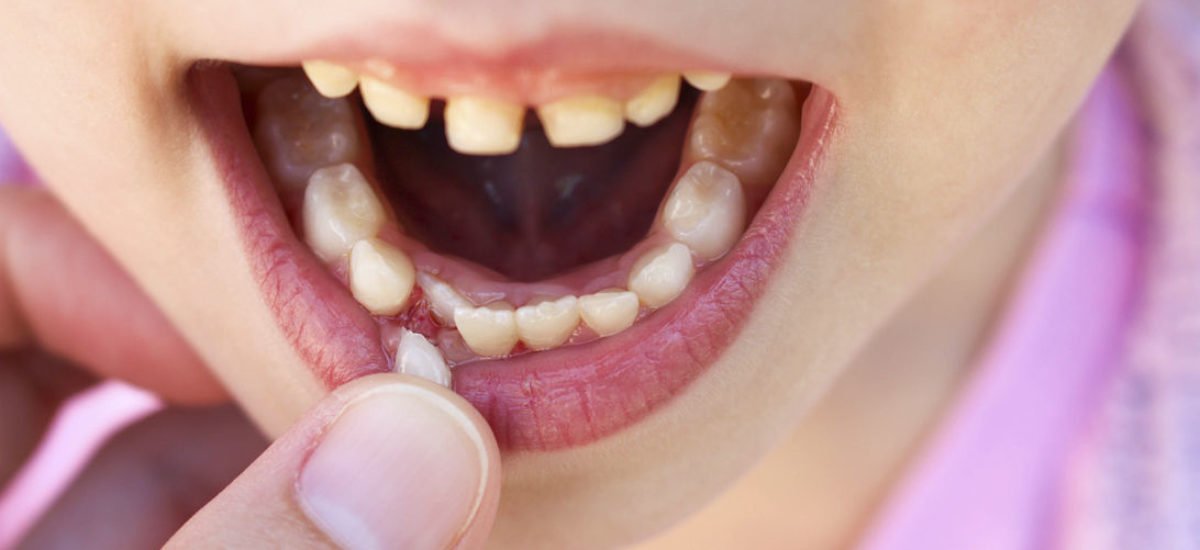 Leche dientes caen