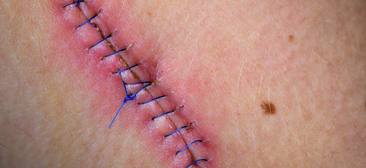 Img cicatrizacion heridas hd