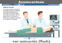 Amniocentesis. Infografías consumer.es