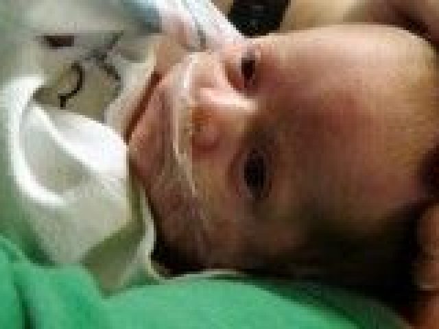 Ninos Prematuros Riesgos Mas Frecuentes Consumer