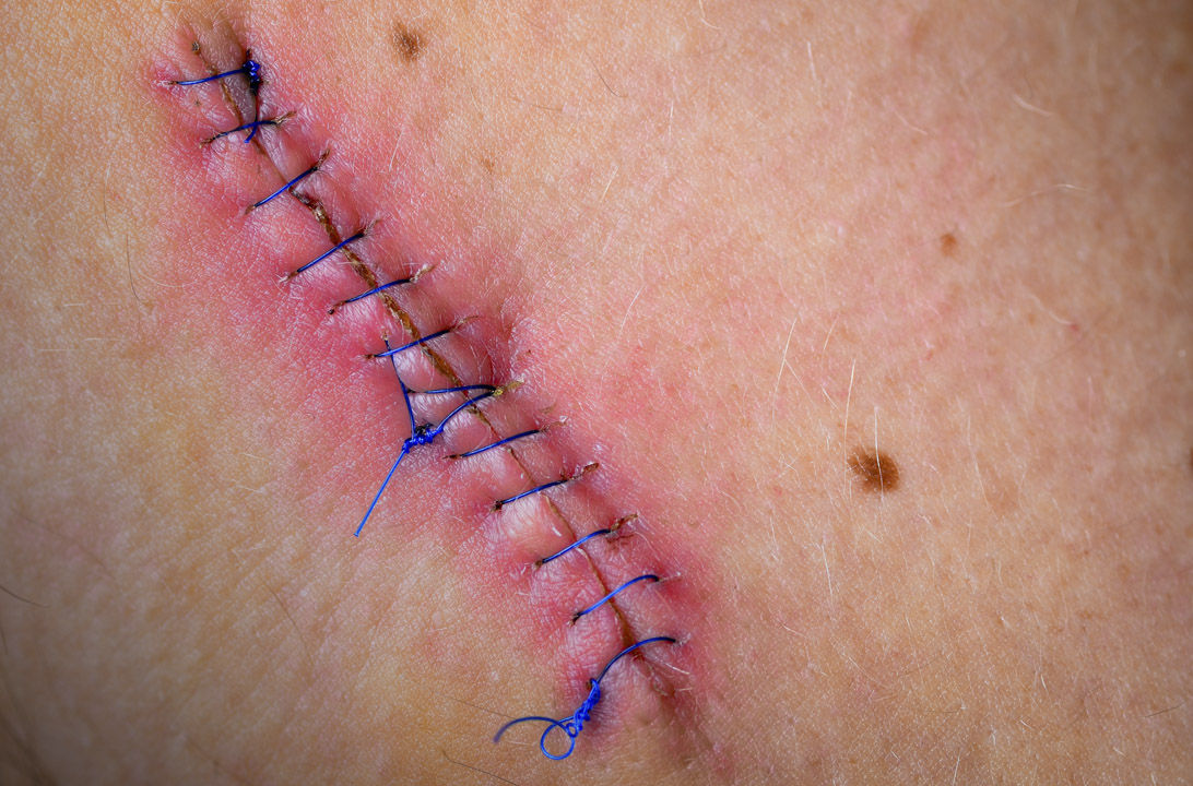 Dificultad para cicatrizar heridas, ¿a qué se debe? | Consumer