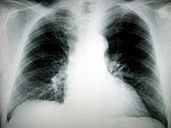 Img pulmon1