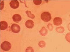 Defizitaren ondorioa: anemia